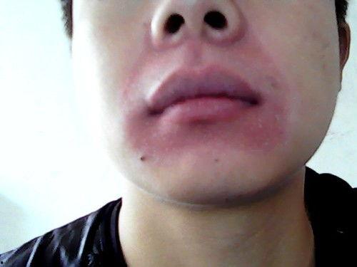 吃瓜嘴巴周围红红的,揭秘嘴巴周围红红的秘密